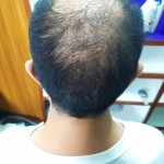 کچلی که دارند براش مو می کاریم توسط دکتر